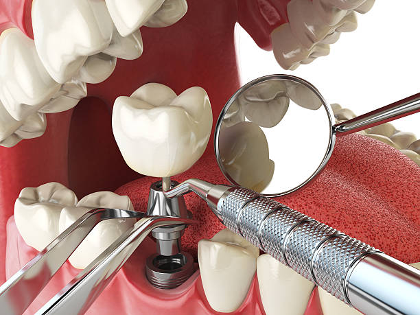 Best Knocked-Out Tooth Emergency  in Healdsburg, CA